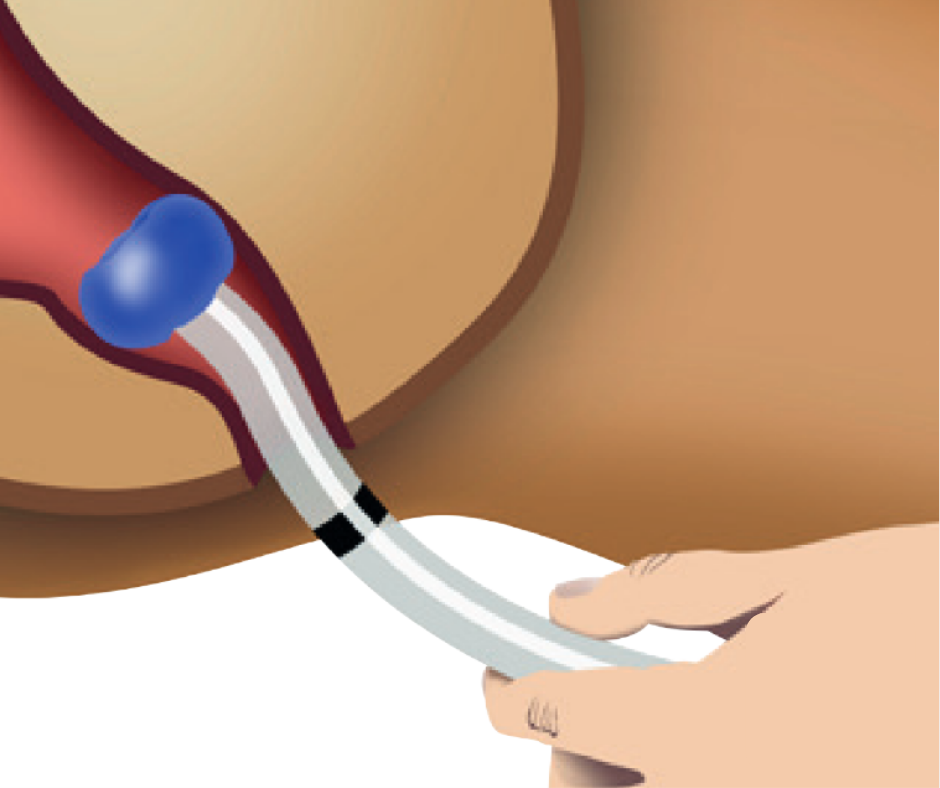 How to apply — Diarflex & Diarflex Advanced