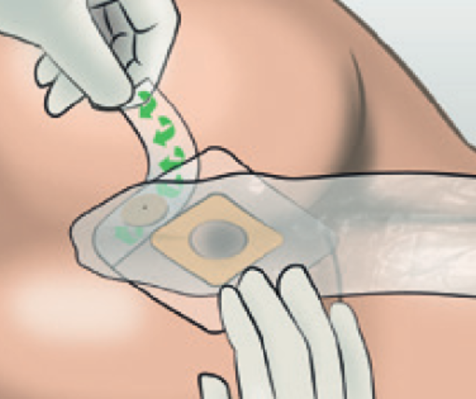 How to apply — Diarflex Faecal Collector